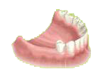 Dent manquante en fond de bouche