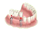 Bridge sur implants