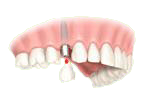 Implant unitaire