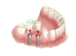 Remplacement par 2 implants sans bridge classique