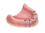 Pose d'implants