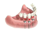 Reconstitution de la dentition