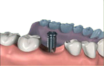 Étape 1 : pose de l'implant