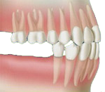 Dents manquantes