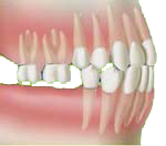 Les dents antagonistes sont perturbées