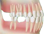 Dent manquante