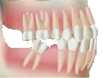 La dent adjacente se déplace