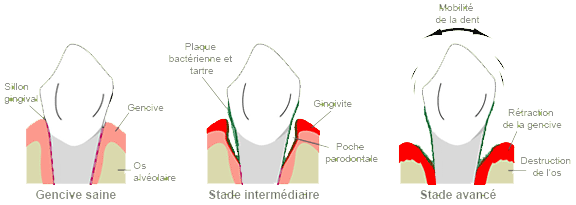 Les parodontites
